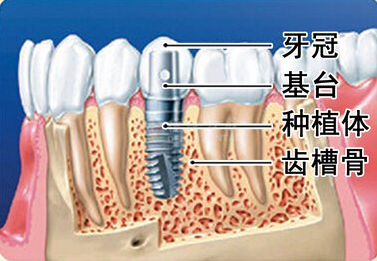 惠州做全口种植牙费用是多少