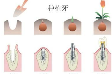 种植牙修复后牙缺失好不好?