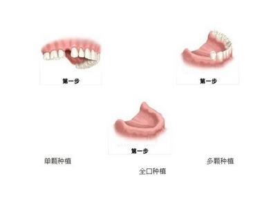 半口牙齿缺失怎么办
