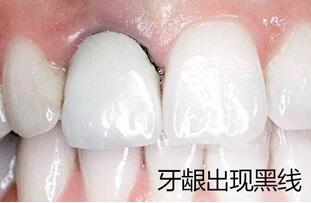 牙龈发黑是怎么回事呢