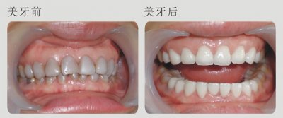 牙齿发黑美白前后
