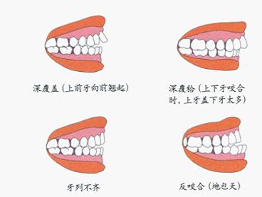 苏州牙齿正畸时间长短以及注意事项