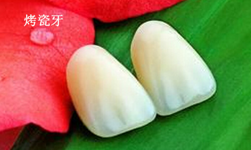 烤瓷牙