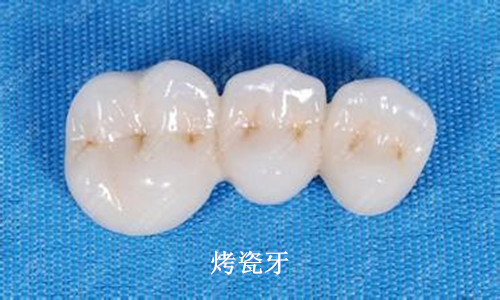 烤瓷牙
