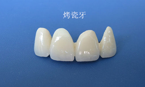 烤瓷牙