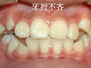 歪牙