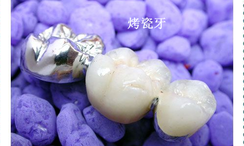 烤瓷牙