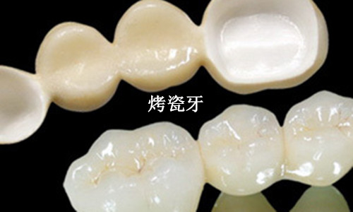 烤瓷牙
