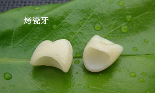 烤瓷牙