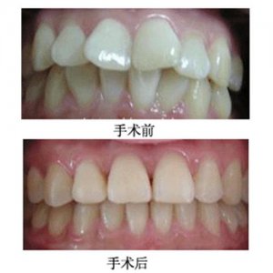 牙齿矫正会损伤牙齿吗