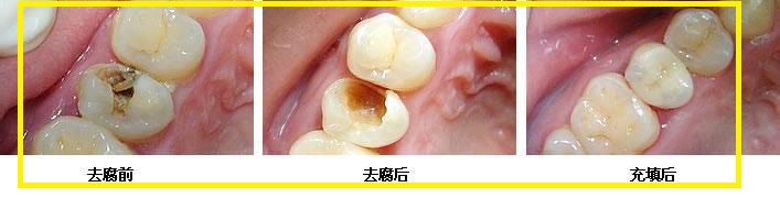 蛀牙 口腔