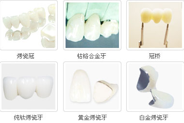 烤瓷牙种类