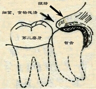 智齿冠周炎的症状