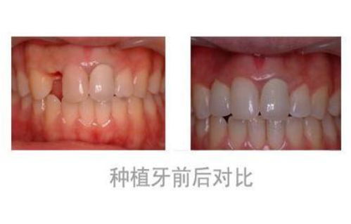 门牙缺失后会有什么危害吗