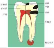 长蛀牙到底怎么办