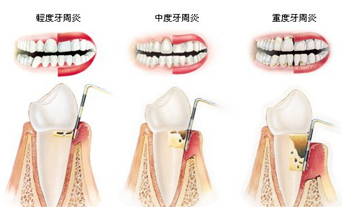 如何预防牙周炎