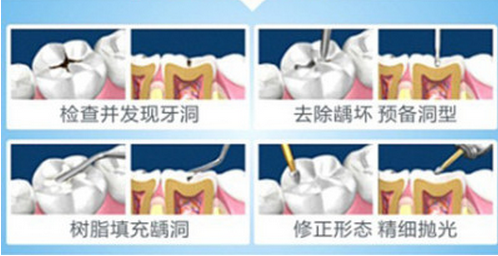 补牙后牙齿能使用多久