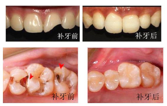 补牙多少钱