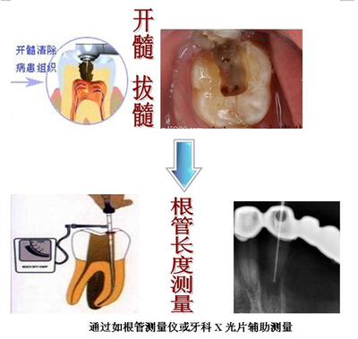 根管治疗多少钱