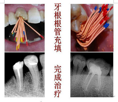 根管治疗多少钱