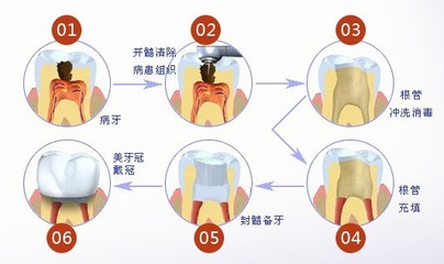 根管治疗多少钱