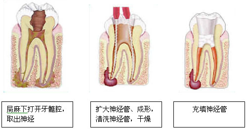 牙齿的根管治疗多少钱