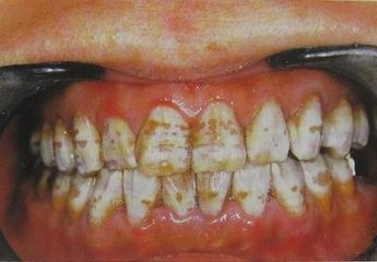 四环素牙是如何形成的呢