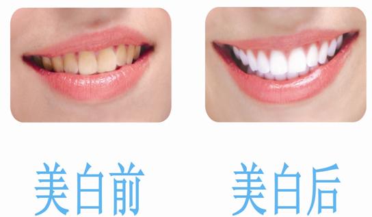 瓷贴面多少钱