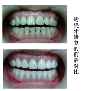 做一颗烤瓷牙多少钱