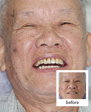 退休干部5颗钉种出半口好牙